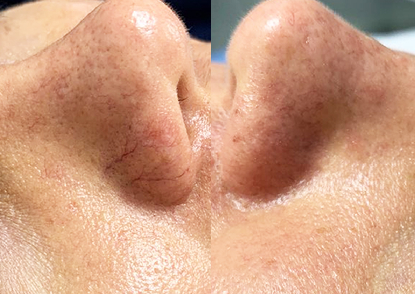 Tratamiento facial con láser Q-Switch y Hollywood Peel